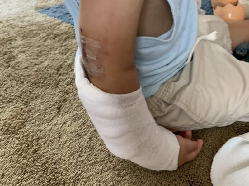 子供の腕手術後の写真。ギブスがずれてきている。