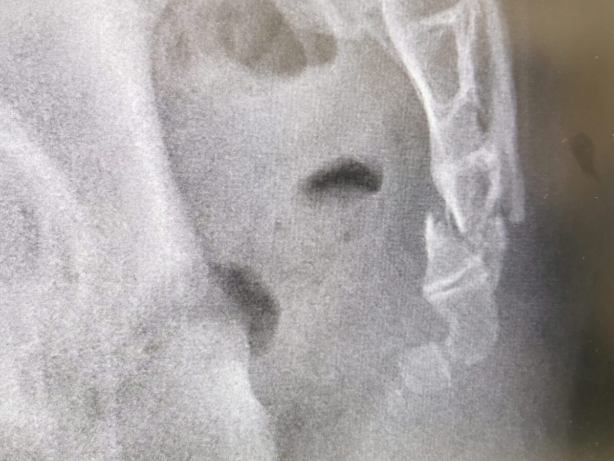 レントゲンで撮った尾骨の骨折部位3週間後